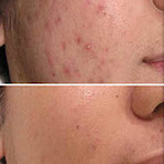 Saúde - Como remover as manchas de espinhas Saúde - Como remover as manchas de espinhas