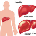 Saúde - HEPATITES - Amarelão, derrame de bile Saúde - HEPATITES - Amarelão, derrame de bile