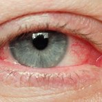 Saúde - Hemorragia subconjuntival, mancha de sangue no olho Saúde - Hemorragia subconjuntival, mancha de sangue no olho